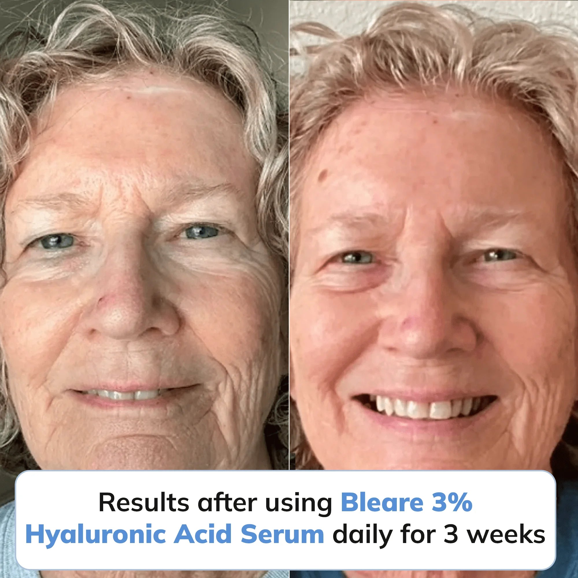 3% Ultra Hydrating Hyaluronic Acid Serum by Bleare™