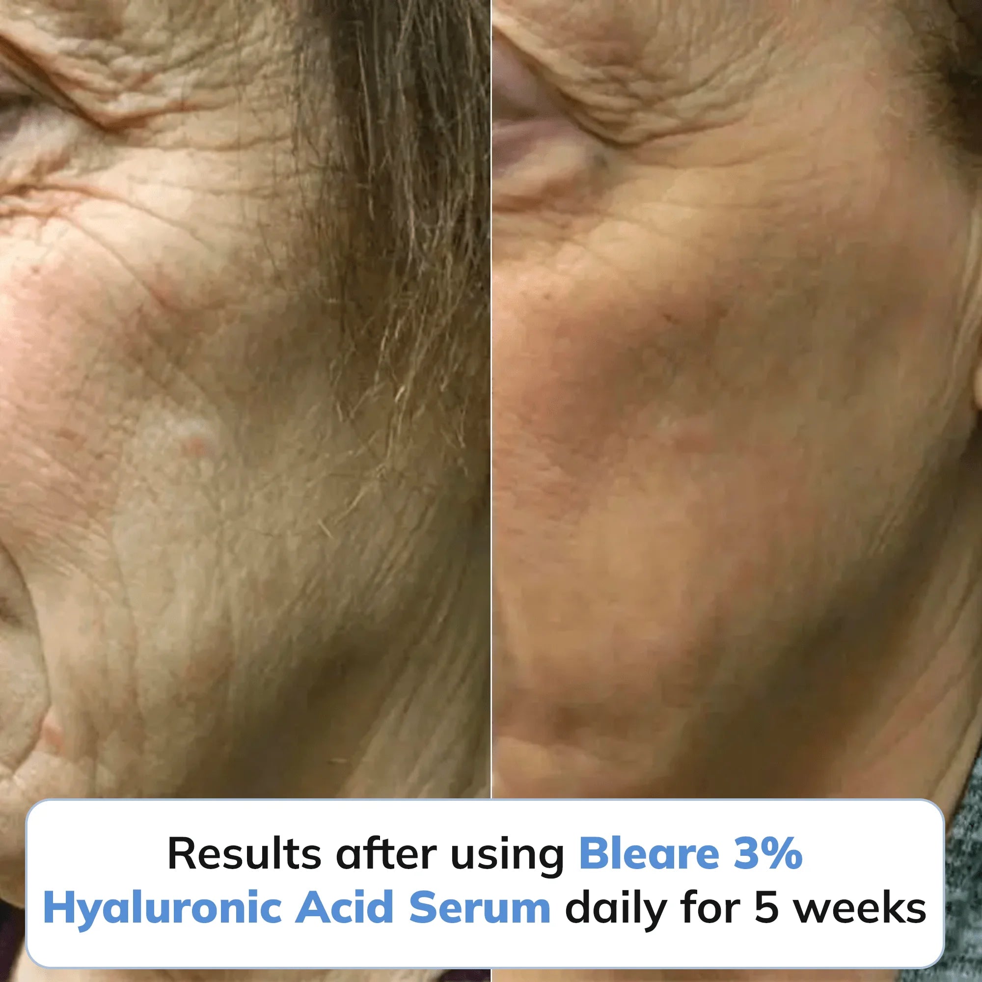 3% Ultra Hydrating Hyaluronic Acid Serum by Bleare™