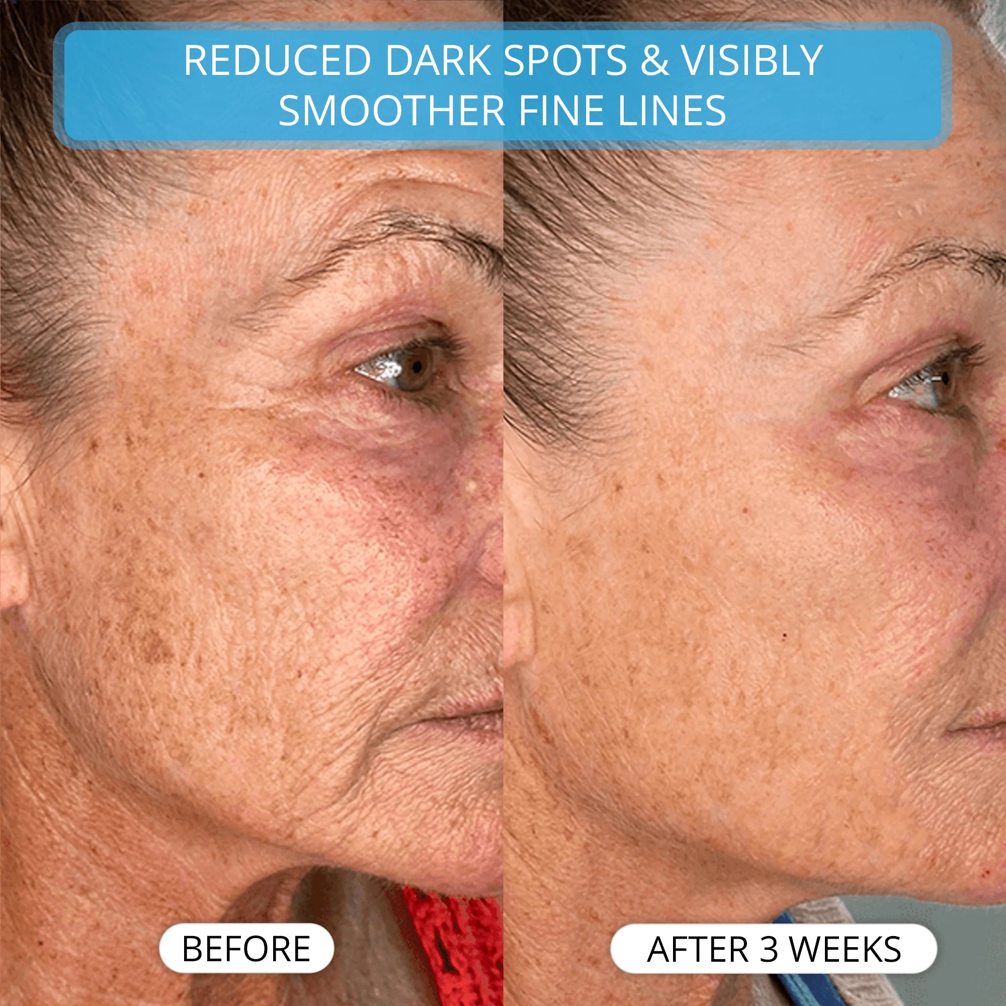 3% Ultra Hydrating Hyaluronic Acid Serum by Bleare™