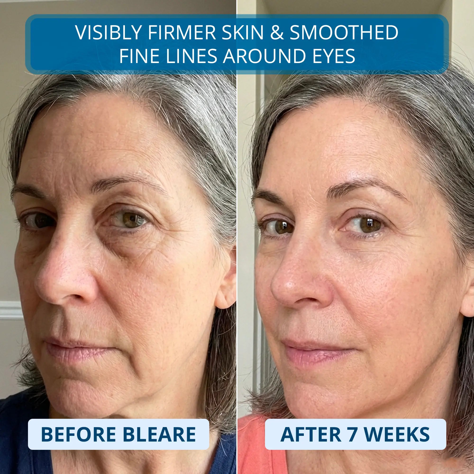 3% Ultra Hydrating Hyaluronic Acid Serum by Bleare™