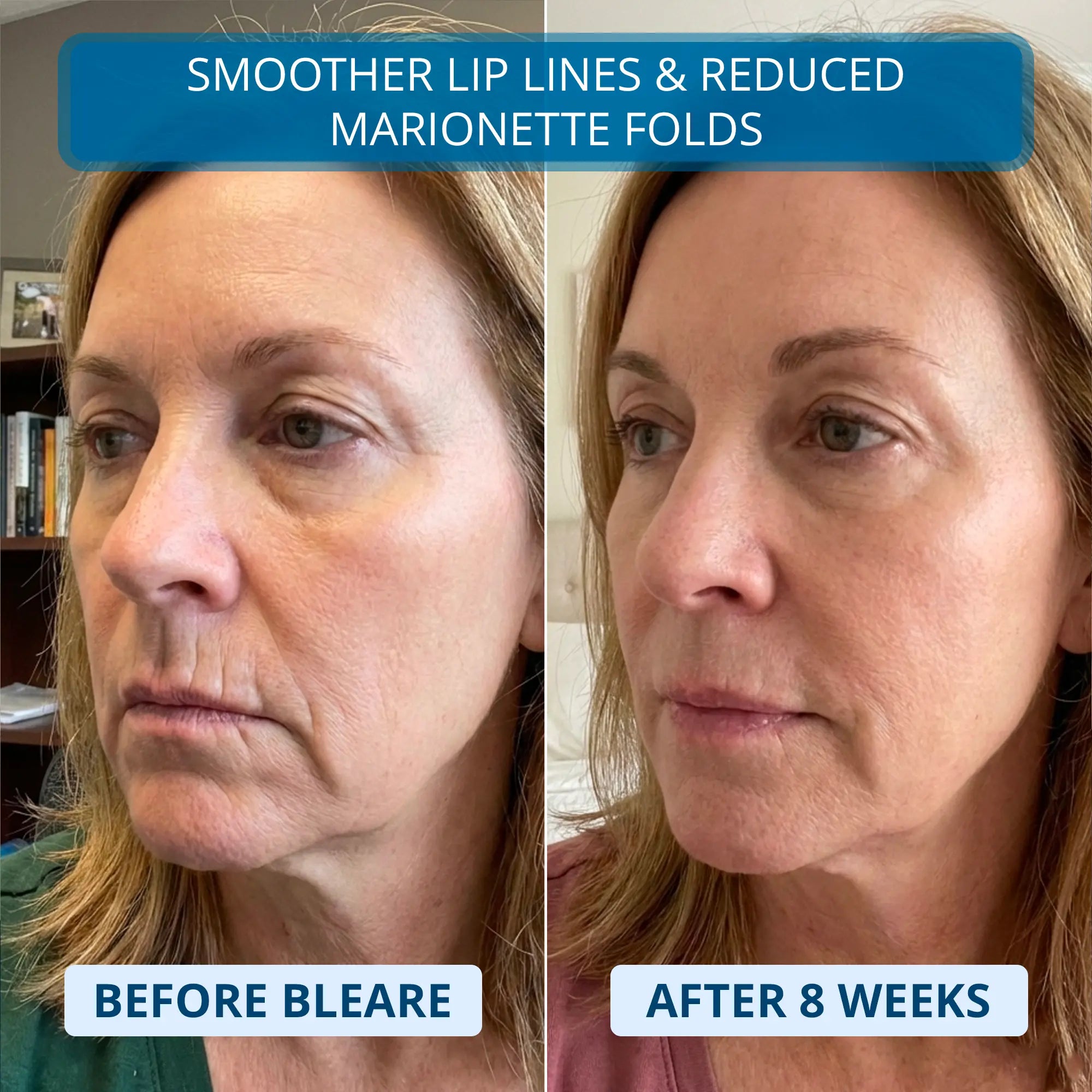 3% Ultra Hydrating Hyaluronic Acid Serum by Bleare™