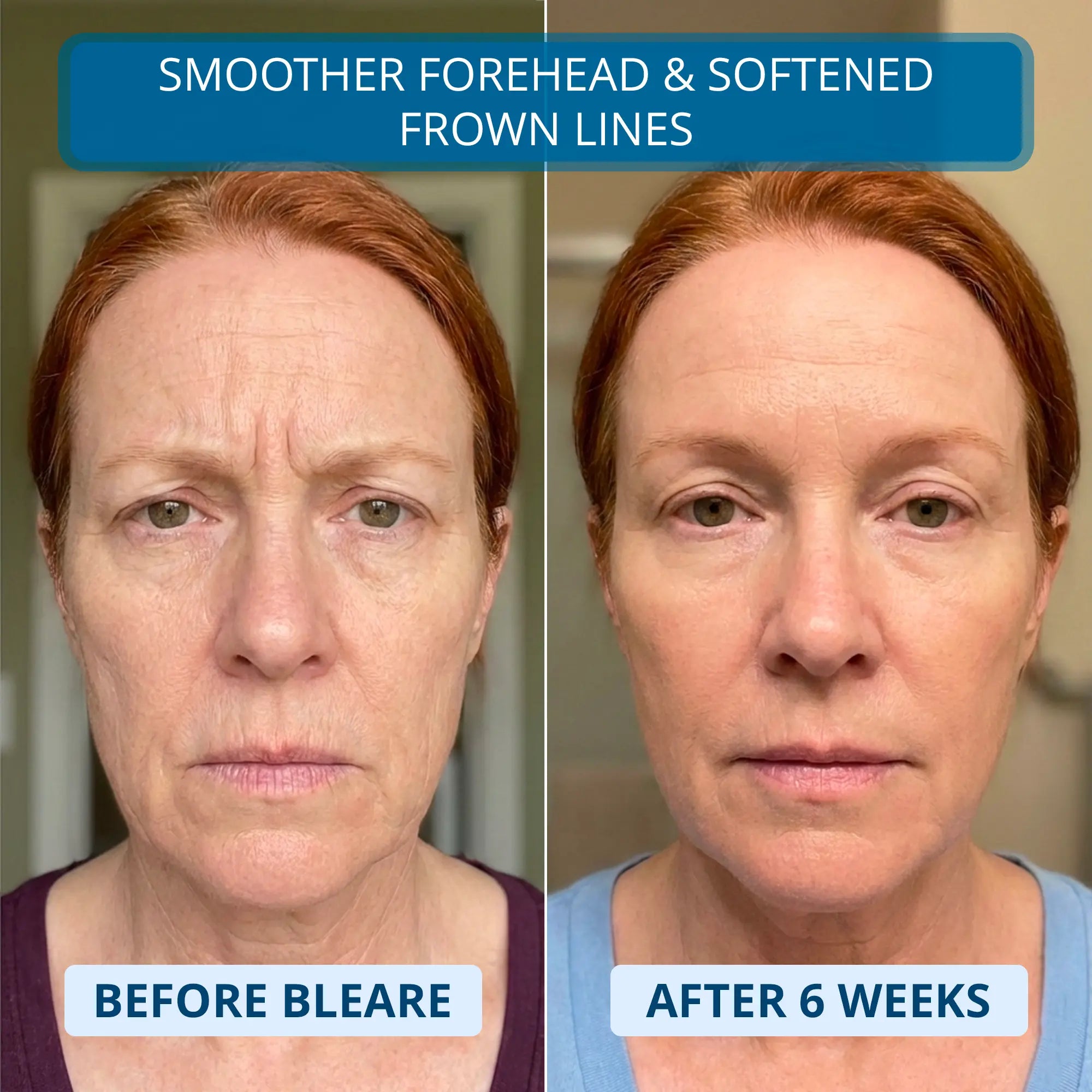 3% Ultra Hydrating Hyaluronic Acid Serum by Bleare™